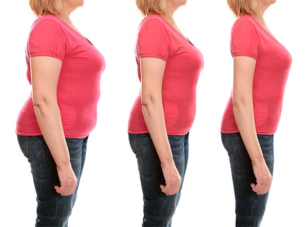 Thinking About Weight Loss Surgery?